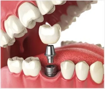 Dental Implants London