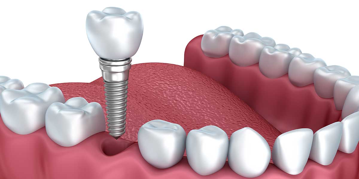 Dental Implants NJ