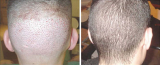 Is FUE Hair Restoration Permanent and What is its Cost?