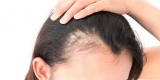 HAIR LOSS TREATMENT MARKET ANALYSIS,2020 – 2027